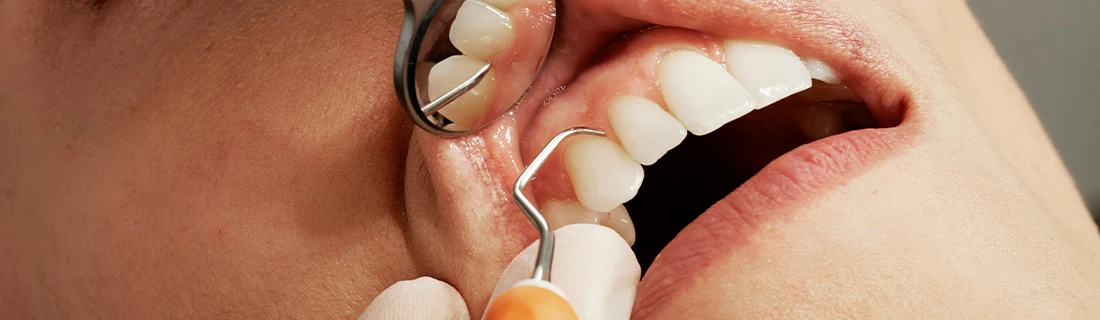 FC – Periodontal Treatment: Gum Disease Care at Canton Dental Group in Canton MA